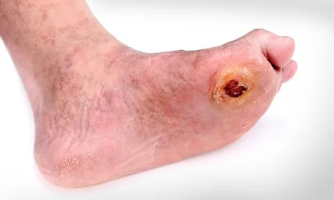 Chronic wounds and emerging innovations in wound care: an overview
