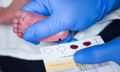 Picture shows a newborn baby undergoing blood spot screening. Research shows that the way parents are told after screening that their child may have cystic fibrosis can affect the depth and duration of their distress.