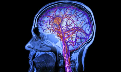 Computer artwork depicts an MRI brain scan revealing the effects of a stroke, showing a blood clot. Upper limb impairment, which occurs in a majority of strokes and requires rehabilitation, is reviewed in three research papers.
