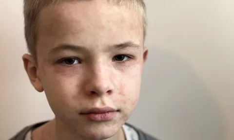 Measles outbreak: cases are on the rise