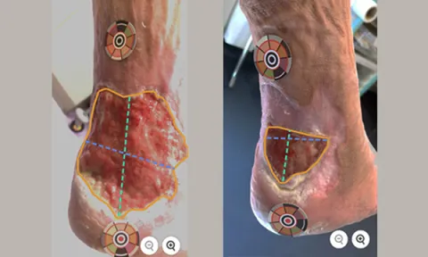 Digital wound management: how it works and its potential benefits in wound care practice