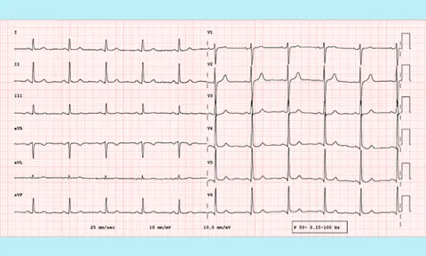 How to accurately record a 12-lead ECG