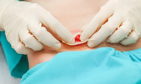 A person wearing disposable gloves provides stoma care to a patient