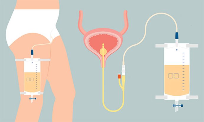 Catheter-associated UTI