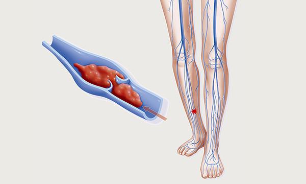 Deep vein thrombosis