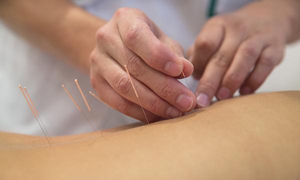 Acupuncture