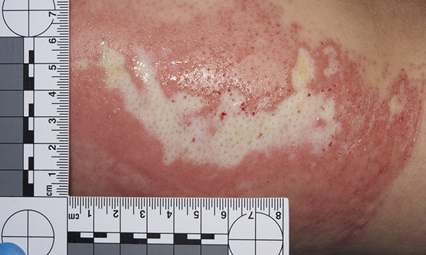 Full-thickness burns due to contact with gastric acid