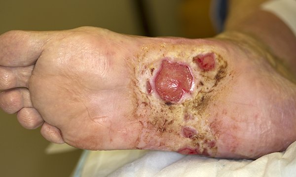 Preventing foot complications in people with diabetes mellitus