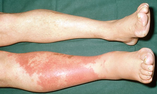 Cellulitis