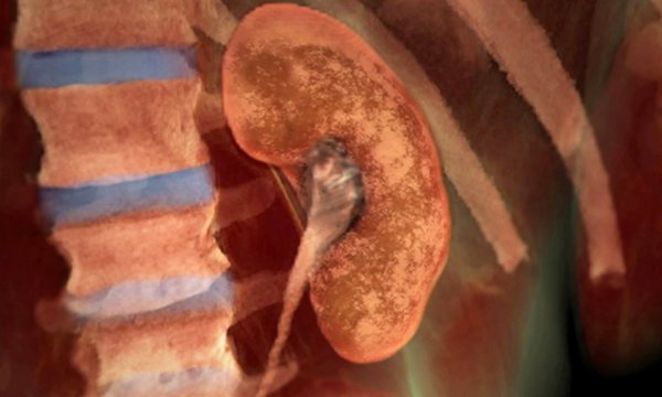 Illustration of a diseased kidney