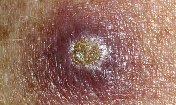 Assessment and treatment of cutaneous leishmaniasis in the emergency department