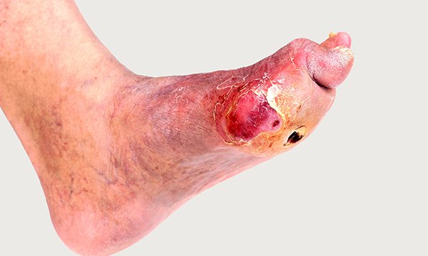 Charcot’s foot: a clinical update for emergency nurses