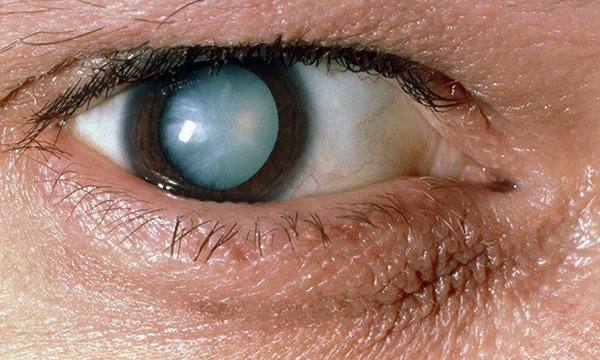 Advanced ophthalmic nurse practitioners: the potential to improve outcomes for older people with cataracts