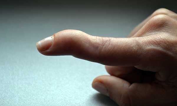 Optimising the conservative management of closed tendinous mallet finger injury