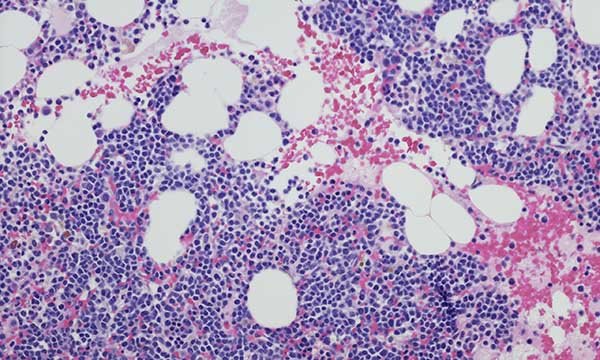 Evaluating a digital self-management tool for people living with multiple myeloma