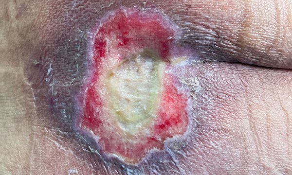 Using the ‘aSSKINg’ model in pressure ulcer prevention and care planning