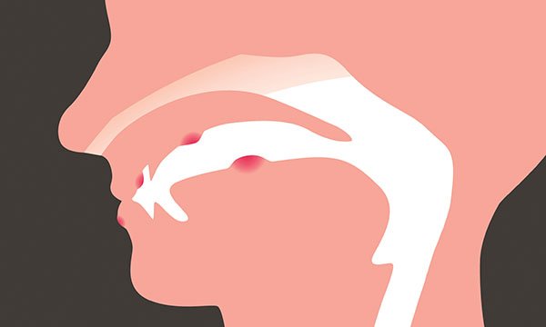 Understanding oral mucositis and the principles of effective mouth care