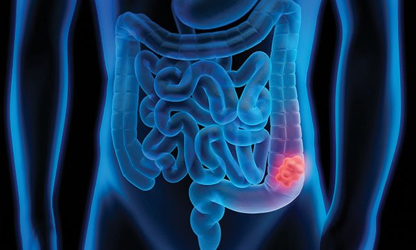 Understanding the routes to diagnosis for colorectal cancer in New Zealand: a protocol paper