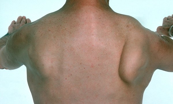 Winged scapula: an overview of pathophysiology, diagnosis and management