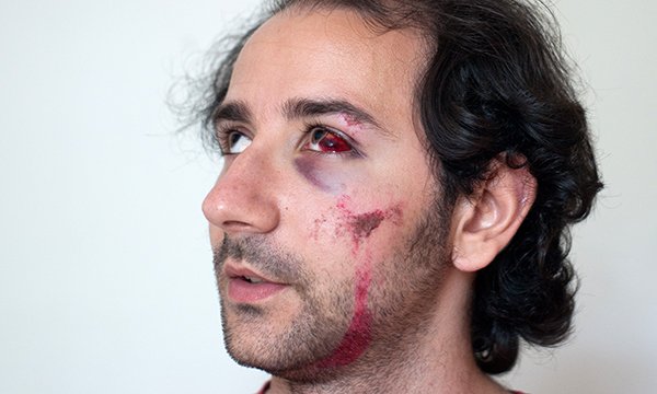 Zygomatic complex fractures in the emergency department: diagnosis and management