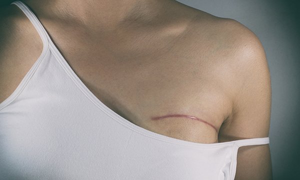 Women’s perceptions of body image post-mastectomy: a literature review