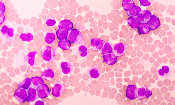 Acute promyelocytic leukaemia: reviewing outcomes of induction treatment with arsenic trioxide and retinoic acid