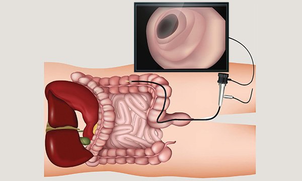 Colonoscopy: an evidence-based approach