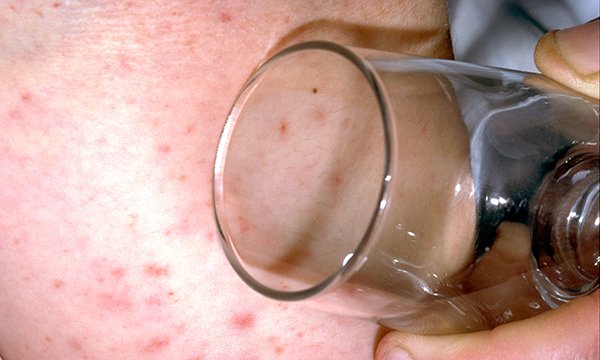 Diagnostic and treatment dilemmas in well children with petechial rash in the emergency department