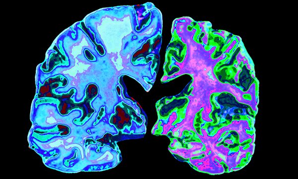 Exploring nursing students’ knowledge of Alzheimer’s disease