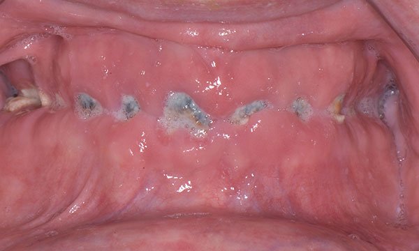 Rapid dental deterioration after radiotherapy for oral cancer: a case report