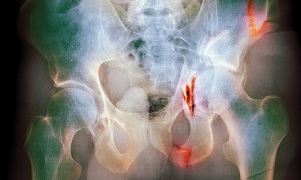 Assessment and management of pelvic fractures from high-energy trauma in adults