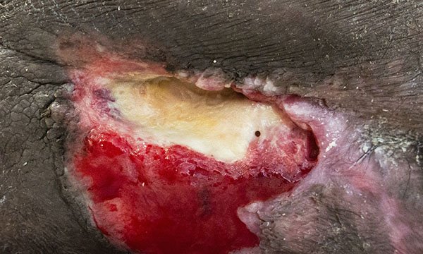 Assessing pressure ulcers in patients with darker skin tones