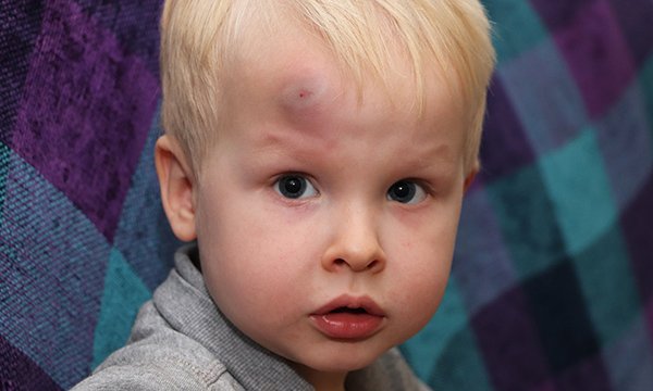 Recognising and responding to bruising in children 