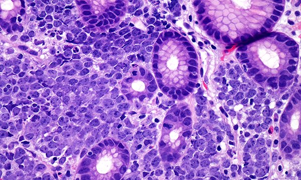 Investigating overall quality of life in patients with diffuse large B-cell lymphoma undergoing CAR T-cell therapy