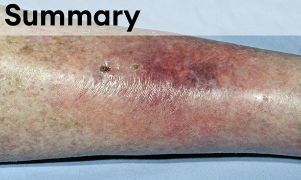 Cellulitis is an acute bacterial infection of the deep dermis and surrounding subcutaneous tissue. Image shows a limb affected by cellulitis