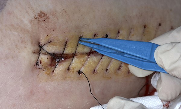 How to remove non-absorbable sutures 