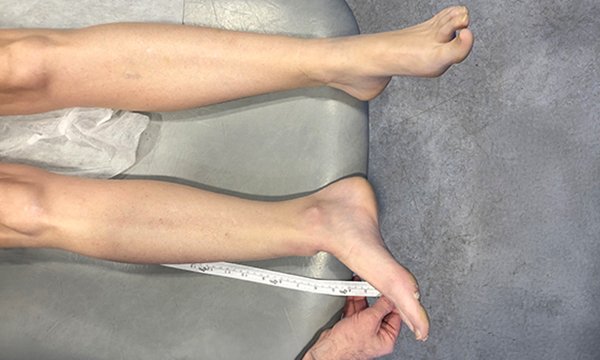 Managing ankle fracture-dislocation injury in the emergency department: a case study