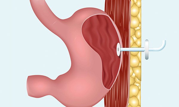 How to administer a percutaneous endoscopic gastrostomy (PEG) feed