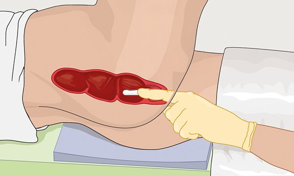 How to administer suppositories in adults with constipation