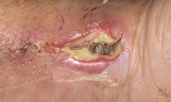 How to assess a wound for signs of infection