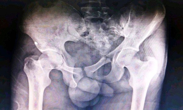 Managing pelvic fractures with haemorrhage using a multidisciplinary team approach: a case report from India