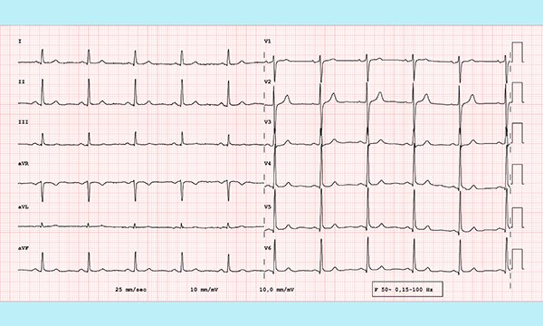 How to accurately record a 12-lead ECG