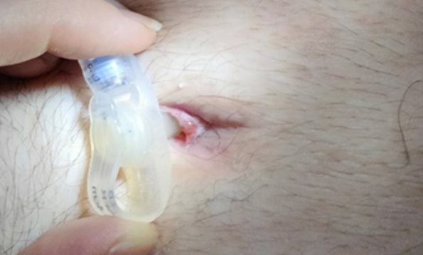 Overgranulation of stoma sites in children with an enteral feeding tube: an evidence-based treatment pathway