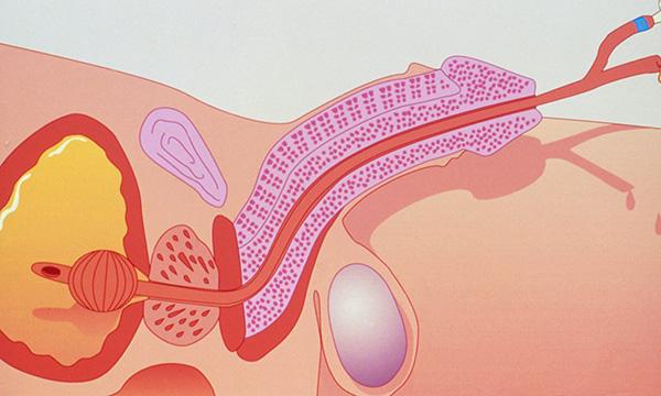 Urinary catheterisation