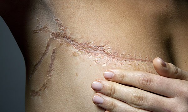 Breast cancer surgery scar