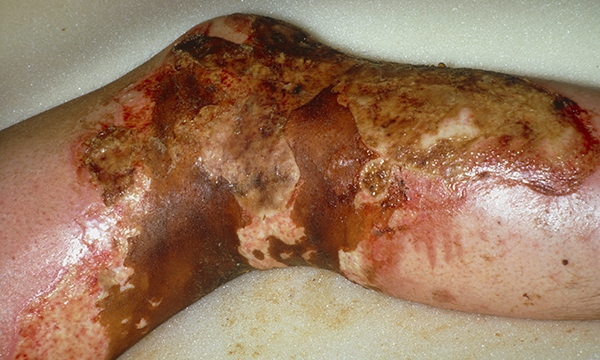 Acute burns