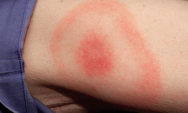 Lyme disease