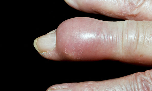 Gout tophus on the finger