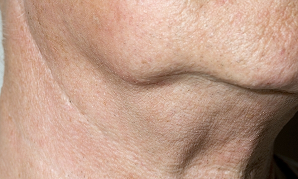 Non-Hodgkin's lymphoma