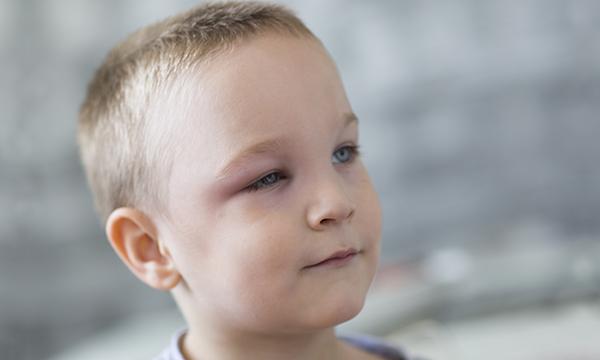 Child_Swollen_Eye
